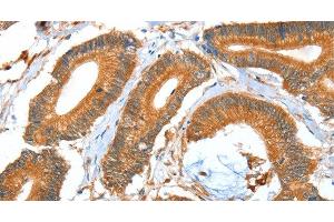 Immunohistochemistry of paraffin-embedded Human colon cancer using ACOT11 Polyclonal Antibody at dilution of 1:40 (ACOT11 Antikörper)