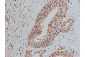 ABIN6267373 at 1/50 staining human colon carcinoma tissue sections by IHC-P.