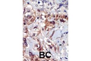 Formalin-fixed and paraffin-embedded human cancer tissue reacted with the primary antibody, which was peroxidase-conjugated to the secondary antibody, followed by AEC staining. (PIP4K2A Antikörper  (C-Term))