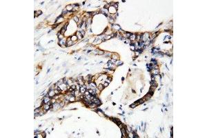 Anti-uPA Receptor antibody, IHC(P) IHC(P): Human Mammary Cancer Tissue (PLAUR Antikörper  (C-Term))