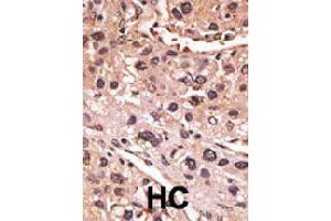 Formalin-fixed and paraffin-embedded human hepatocellular carcinoma tissue reacted with MAGEA12 polyclonal antibody  , which was peroxidase-conjugated to the secondary antibody, followed by AEC staining. (MAGEA12 Antikörper  (N-Term))