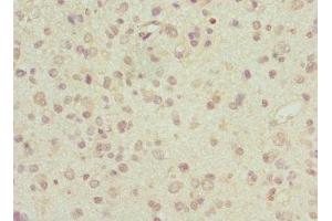 Immunohistochemistry of paraffin-embedded human glioma using ABIN7143513 at dilution of 1:100 (ARL6 Antikörper  (AA 1-186))