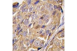 IHC analysis of FFPE human breast carcinoma tissue stained with EIF4B antibody (EIF4B Antikörper  (AA 400-429))