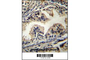 STAMBP Antibody immunohistochemistry analysis in formalin fixed and paraffin embedded human prostate carcinoma followed by peroxidase conjugation of the secondary antibody and DAB staining.