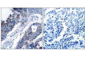 Immunohistochemical analysis of paraffin- embedded human breast carcinoma tissue, using ASK1 (Ab-83) antibody (E021125). (ASK1 Antikörper)