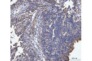 IHC analysis of MUC1 using anti-MUC1 antibody (ABIN7602711). (MUC1 Antikörper  (AA 979-1095))