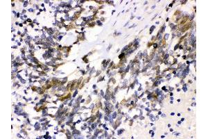 Anti- Cdk4 Picoband antibody, IHC(P) IHC(P): Human Lung Cancer Tissue (CDK4 Antikörper  (AA 201-303))