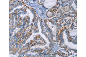 Immunohistochemistry of Human thyroid cancer using GPA33 Polyclonal Antibody at dilution of 1:30 (GPA33 Antikörper)