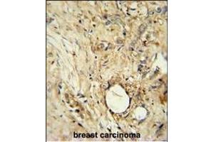 ITIH5 Antibody (C-term) (ABIN654918 and ABIN2844563) immunohistochemistry analysis in formalin fixed and paraffin embedded human breast carcinoma followed by peroxidase conjugation of the secondary antibody and DAB staining. (ITIH5 Antikörper  (C-Term))