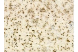 ABIN6264449 and ABIN6273150 at 1/100 staining human melanoma by IHC-P.