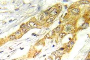 Immunohistochemistry (IHC) analyzes of ERK1/2 antibody in paraffin-embedded human breast carcinoma tissue. (ERK1/2 Antikörper)