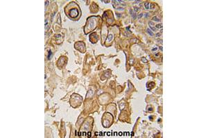 Formalin-fixed and paraffin-embedded human lung carcinomareacted with Tlr6 polyclonal antibody , which was peroxidase-conjugated to the secondary antibody, followed by AEC staining. (TLR6 Antikörper  (C-Term))