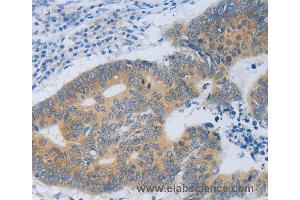 Immunohistochemistry of Human colon cancer using MT2A Polyclonal Antibody at dilution of 1:40 (MT2A Antikörper)