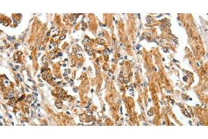 Immunohistochemistry of paraffin-embedded Human gastric cancer tissue using TGF β Receptor I Polyclonal Antibody at dilution 1:60 (TGFBR1 Antikörper)