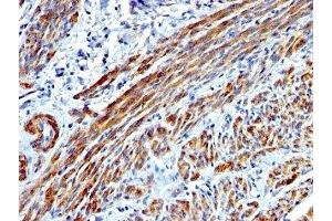 Formalin-fixed, paraffin-embedded human Leiomyosarcoma stained with SMMHC antibody (MYH11/923). (MYH11 Antikörper)