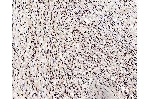 Immunohistochemistry analysis of paraffin-embedded human lung cancer using c-Fos Polyclonal Antibody at dilution of 1:200. (c-FOS Antikörper)