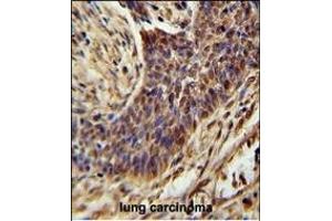 ZSWIM1 Antibody (C-term) (ABIN654558 and ABIN2844265) immunohistochemistry analysis in formalin fixed and paraffin embedded human lung carcinoma followed by peroxidase conjugation of the secondary antibody and DAB staining. (ZSWIM1 Antikörper  (C-Term))