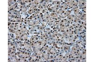 Immunohistochemical staining of paraffin-embedded Adenocarcinoma of colon tissue using anti-APP mouse monoclonal antibody. (APP Antikörper)