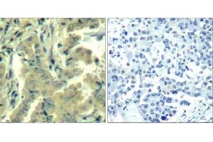 Immunohistochemical analysis of paraffin-embedded human lung carcinoma tissue using PLC-γ2 (Ab-1217) Antibody (E021524). (Phospholipase C gamma 2 Antikörper)