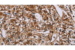 Immunohistochemistry of paraffin-embedded Human prostate cancer using BMP6 Polyclonal Antibody at dilution of 1:50 (BMP6 Antikörper)