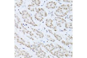 Immunohistochemistry of paraffin-embedded human colon carcinoma using SIRT1 antibody (ABIN6291361) at dilution of 1:100 (40x lens).