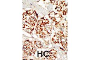 Formalin-fixed and paraffin-embedded human hepatocellular carcinoma tissue reacted with KSR1 polyclonal antibody  , which was peroxidase-conjugated to the secondary antibody, followed by DAB staining.