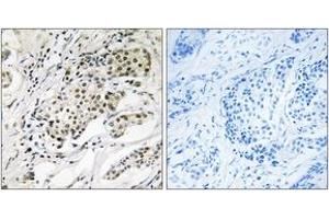 Immunohistochemistry analysis of paraffin-embedded human breast carcinoma, using CDYL2 Antibody. (CDYL2 Antikörper  (AA 31-80))