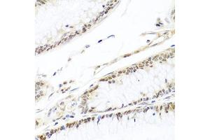 Immunohistochemistry of paraffin-embedded human colon carcinoma using HIRA antibody (ABIN6128018, ABIN6141776, ABIN6141778 and ABIN6224528) at dilution of 1:100 (40x lens). (HIRA Antikörper  (AA 250-550))