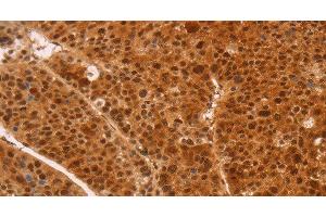 Immunohistochemistry of paraffin-embedded Human liver cancer tissue using HEXIM1 Polyclonal Antibody at dilution 1:65 (HEXIM1 Antikörper)