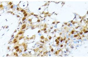 Immunohistochemistry of paraffin-embedded Human breast cancer using PRMT1 Polyclonal Antibody at dilution of 1:100 (40x lens). (PRMT1 Antikörper)