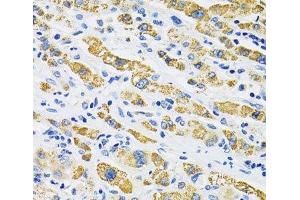 Immunohistochemistry of paraffin-embedded Human liver cancer using SLC16A4 Polyclonal Antibody at dilution of 1:100 (40x lens). (SLC16A4 Antikörper)