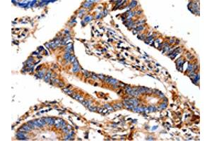 The image on the left is immunohistochemistry of paraffin-embedded Human colon cancer tissue using ABIN7129022(COX8A Antibody) at dilution 1/12, on the right is treated with fusion protein. (COX8A Antikörper)