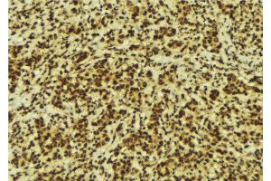 ABIN6267061 at 1/100 staining Human breast cancer tissue by IHC-P.