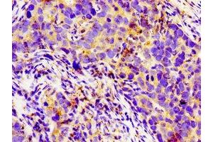 Immunohistochemistry of paraffin-embedded human pancreatic cancer using ABIN7158134 at dilution of 1:100 (LGR6 Antikörper  (AA 839-962))