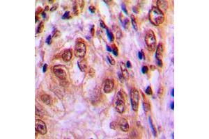 Immunohistochemical analysis of STAT4 (pY693) staining in human lung cancer formalin fixed paraffin embedded tissue section. (STAT4 Antikörper  (C-Term, pTyr693))