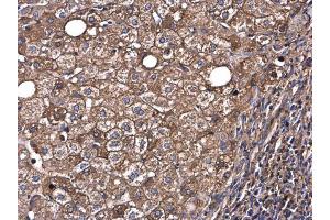 IHC-P Image Albumin antibody detects Albumin protein at cytoplasm in human hepatocellular carcinoma by immunohistochemical analysis.
