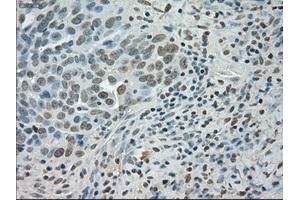 Immunohistochemical staining of paraffin-embedded Adenocarcinoma of colon tissue using anti-SATB1mouse monoclonal antibody. (SATB1 Antikörper)