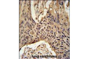 LPPR4 Antibody immunohistochemistry analysis in formalin fixed and paraffin embedded human lung carcinoma followed by peroxidase conjugation of the secondary antibody and DAB staining.