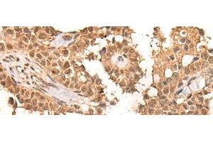 Immunohistochemistry of paraffin-embedded Human ovarian cancer tissue using CLK2 Polyclonal Antibody at dilution of 1:45(x200) (CLK2 Antikörper)