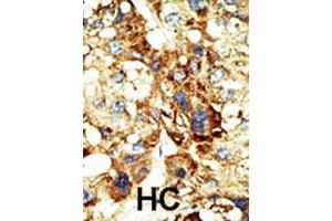 Formalin-fixed and paraffin-embedded human hepatocellular carcinoma tissue reacted with the primary antibody DNMT3A polyclonal antibody  , which was peroxidase-conjugated to the secondary antibody, followed by DAB staining. (DNMT3A Antikörper  (Internal Region))