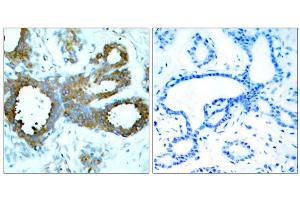Immunohistochemical analysis of paraffin-embedded human breast carcinoma tissue, using PAK1/PAK2/PAK3 (Phospho-Thr423/Thr402/Thr421) antibody (E011165). (PAK1/2/3 Antikörper  (pThr402, pThr421, pThr423))