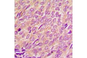 Immunohistochemical analysis of Cytochrome P450 4Z1/2 staining in human breast cancer formalin fixed paraffin embedded tissue section. (Cytochrome P450 4Z1/2 (Center) Antikörper)