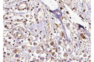 ABIN6279467 at 1/100 staining Human breast cancer tissue by IHC-P. (RABIF Antikörper  (N-Term))
