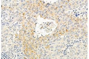 ABIN6265621 and ABIN6272881 at 1/100 staining Human lung cancer by IHC-P. (TMPRSS4 Antikörper  (Internal Region))