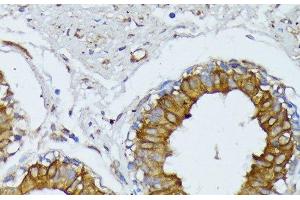 Immunohistochemistry of paraffin-embedded Human mammary cancer using WNT1 Polyclonal Antibody at dilution of 1:100 (40x lens). (WNT1 Antikörper)