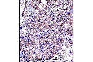 P11 Antibody (C-term) ((ABIN657651 and ABIN2846646))iunohistochemistry analysis in formalin fixed and paraffin embedded human breast carcinoma followed by peroxidase conjugation of the secondary antibody and DAB staining. (MMP11 Antikörper  (C-Term))