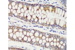 Immunohistochemistry of paraffin-embedded Human colon carcinoma using TOM20 Polyclonal Antibody at dilution of 1:100 (40x lens). (TOMM20 Antikörper)