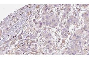 ABIN6273928 at 1/100 staining Human liver cancer tissue by IHC-P. (GPR161 Antikörper  (Internal Region))