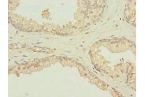 Immunohistochemistry of paraffin-embedded human prostate cancer using ABIN7168604 at dilution of 1:100 (SCAND1 Antikörper  (AA 1-179))