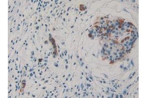 DAB staining on IHC-P; Samples: Human Pancreatic cancer Tissue (THBS3 Antikörper  (AA 670-921))